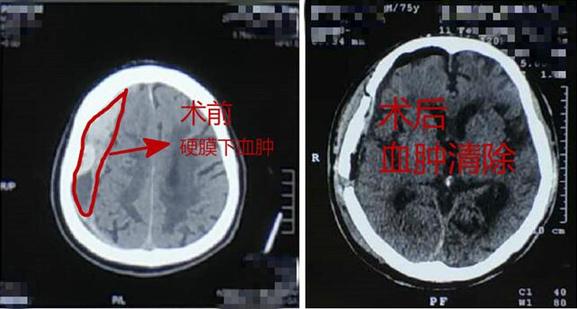 意外磕到頭不重視 當(dāng)心出大問題