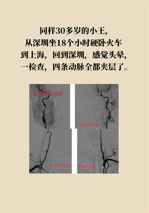 這個動作讓多名年輕人中風了，一定要重視！