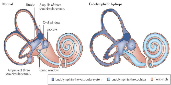 “耳水不平衡”是什么病？