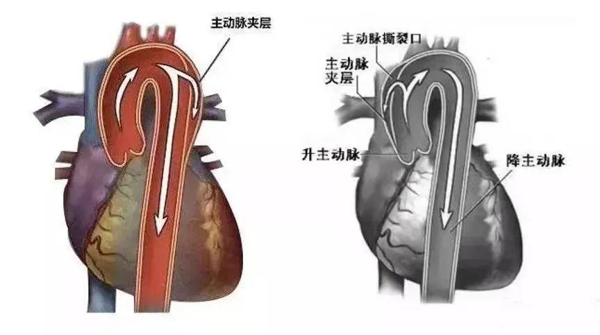 5天接診4例A型主動脈夾層，到底有多兇險