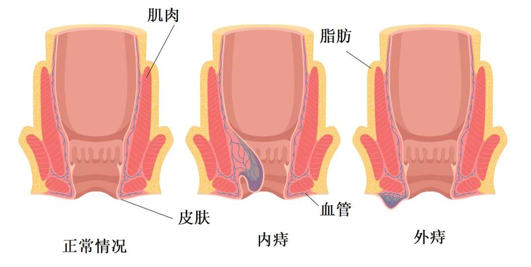 久坐的危害有多大？不只有血管功能下降、注意力不集中……