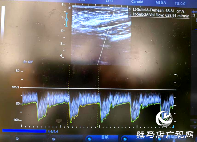 市內首例!內瘺上臂段覆膜支架植入打通透析“生命線”