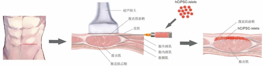 事關(guān)糖尿病治療，我國科學(xué)家取得突破